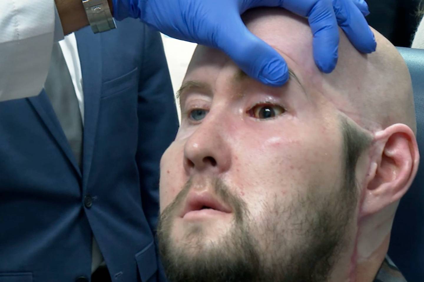 Man blinded by 7,000-volt electric shock receives world's first whole eye transplant