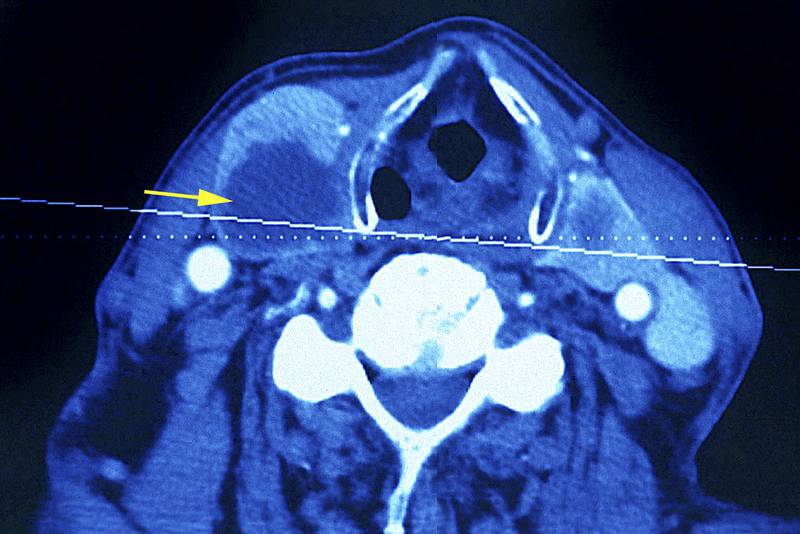 A CT scan of a patient's neck (not the writer's) reveals a thyroid tumour (Photo By BSIP/UIG Via Getty Images)