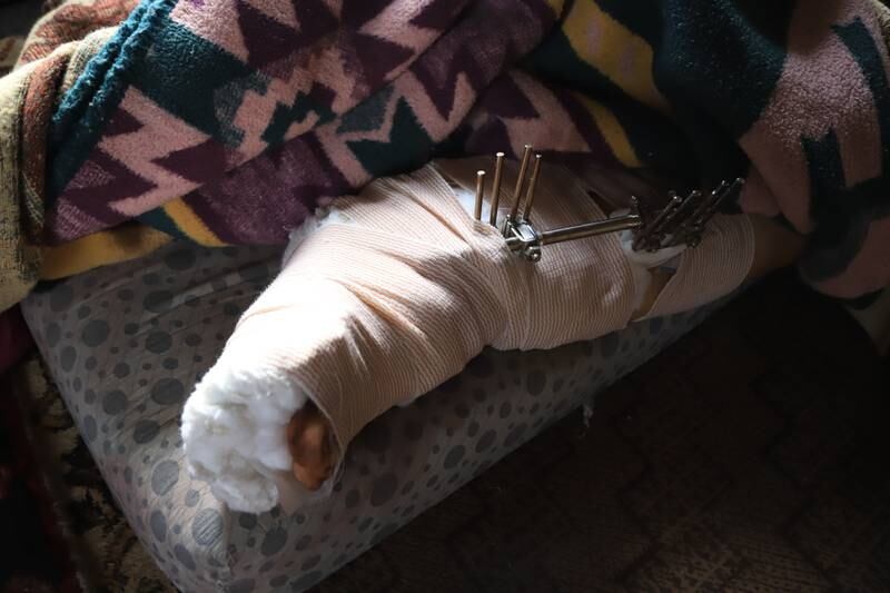 Metal equipment installed on Fatima’s leg.