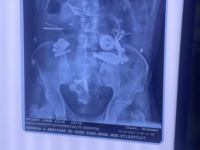 An X-ray showing 150 foreign objects in a man's stomach at Medicity Hospital in Moga, Punjab, India. Ajemr Kalra / Moga Hospital