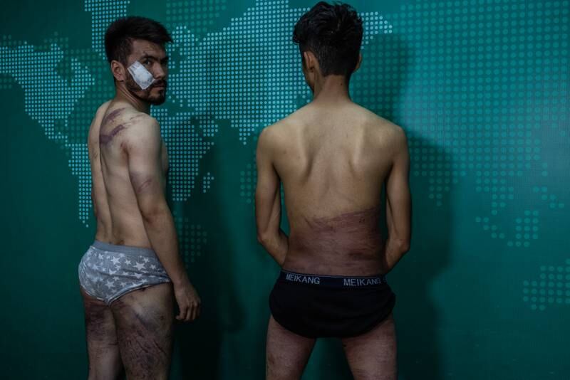 Nehmatullah Naqdi (left) and Taqi Daryabi show their scars..  
