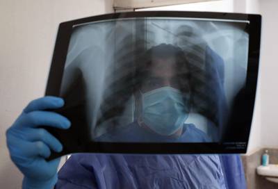 Medical personnel checks an X-ray at the Imbaba Fevers Hospital in Cairo. EPA