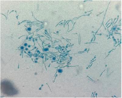 A mycologist from Kolkata city was infected by a fungal disease caused by the pathogen Chondrostereum purpureum. Photo: Medical Mycology Case Reports
