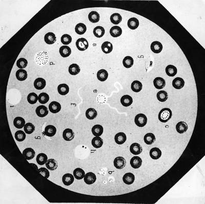 FOR MALARIA / SMALPOX GALLERY. circa 1893:  A view through a microscope of fresh blood, possibly infected with malaria.  (Photo by Hulton Archive/Getty Images)
