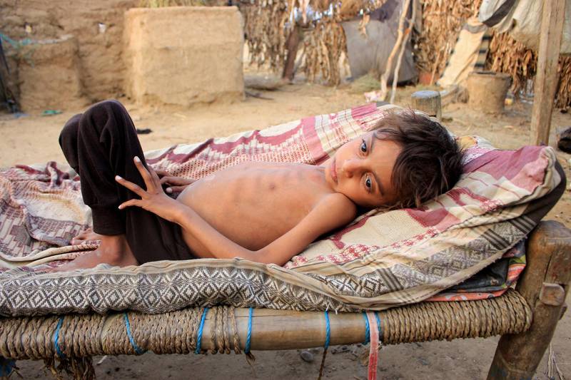 Malnourished boy Hassan Merzam Muhammad lies on a bed at his family's hut in Abs district of Hajjah province, Yemen. REUTERS