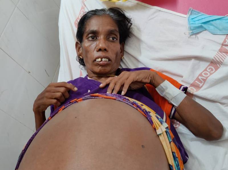 Nagamma, 46, before doctors in India’s Andhra Pradesh state operated on her to remove an ovarian tumour weighing 35 kilograms. Photo:  Dr K Madhavi