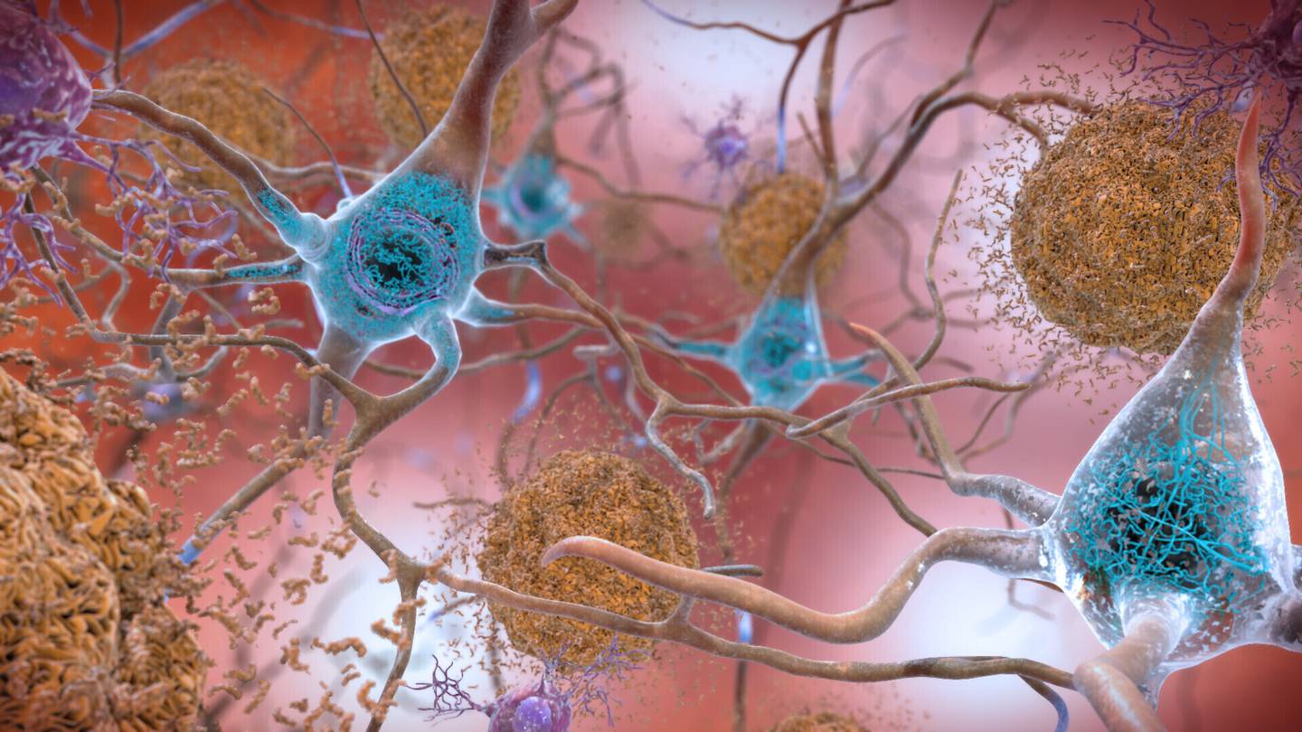 Cells in an Alzheimer’s-affected brain, with abnormal levels of the beta-amyloid protein clumping together to form plaque – brown in the rendering – that disrupts cell function. AP