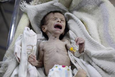 A Syrian infant suffering from severe malnutrition is seen at a clinic in Hamouria, Ghouta region on the outskirts of the capital Damascus. Amer Almohibany / AFP Photo / October 21, 2017