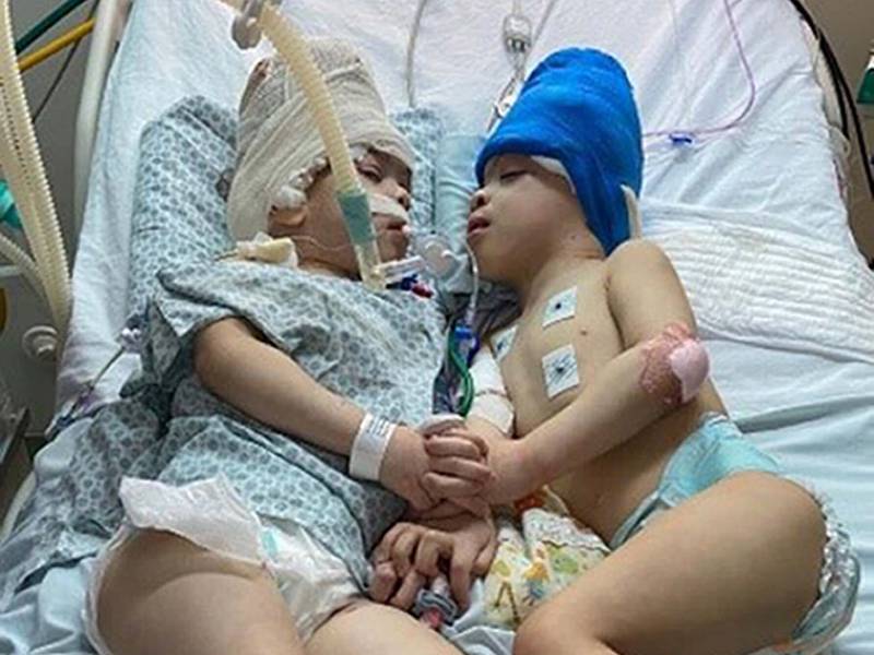 Brazilian twins Bernardo (left) and Arthur Lima who have been successfully separated. Gemini Untwined