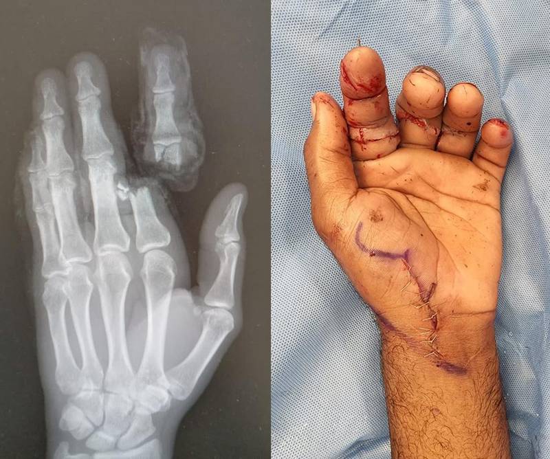 Mohamed Mansour Mohamed severed his finger in an accident involving a window. Photo: Burjeel Medical City