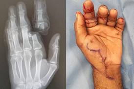 Man thanks Abu Dhabi doctors who reattached his severed finger