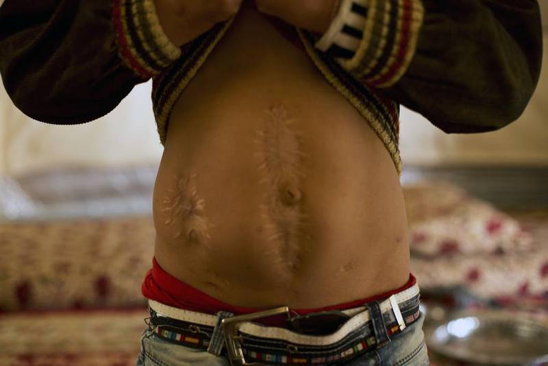 Akram shows the scars he sustained when ISIL militants attacked his town in 2014. ‘They started to shoot at us. My mother fell and I was hit. These are the bullet marks.’