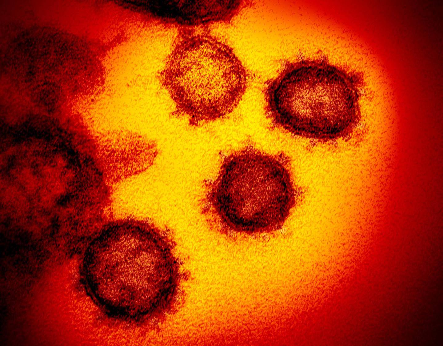FILE - This undated electron microscope image made available by the U.S. National Institutes of Health in February 2020 shows the Novel Coronavirus SARS-CoV-2. Also known as 2019-nCoV, the virus causes COVID-19. The sample was isolated from a patient in the U.S. On Tuesday, April 21, 2020, U.S. health regulators OK'd the first coronavirus test that allows people to collect their own sample at home, a new approach that could help expand testing options in most states. The sample will still have to be shipped for processing back to LabCorp, which operates diagnostic labs throughout the U.S. (NIAID-RML via AP)
