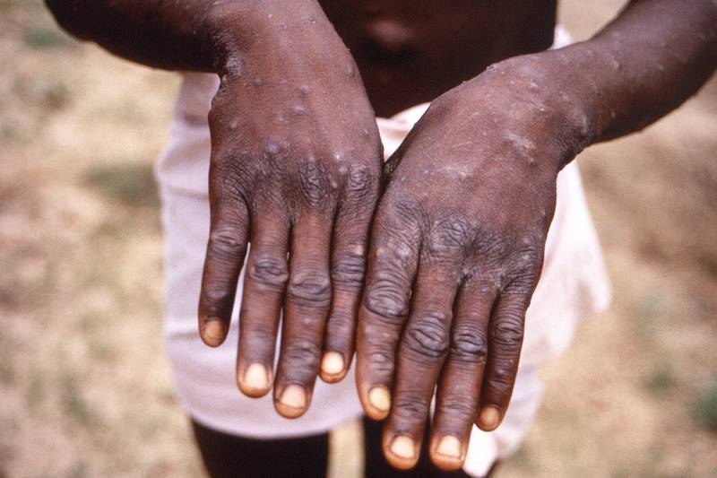 A man's hands are covered in a rash caused by the monkeypox virus that swept through the Democratic Republic of the Congo from 1996 to 1997. Reuters