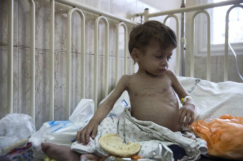 Malnutrition can also have severe secondary effects. Four-year-old Omar Albaradee is surrounded by food in his hospital bed to encourage him to eat . He has been to the Naser hospital over 27 times for immune deficiency, now compounded by severe malnourishment, said his father, Saed Mohamed Albaradee. Twenty-eight-year-old Albaradee lives in Tel Al-Hawa in Gaza City, finished high school and now like so many Gazans is ��a��ed�� �� ��sitting�� without a job..(Photo by Heidi Levine for The National).