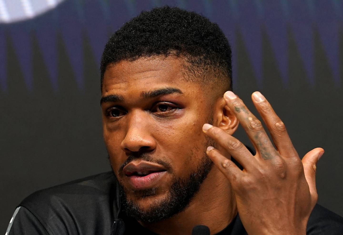 A close up of Anthony Joshua's injuries during a press conference after the fight. PA