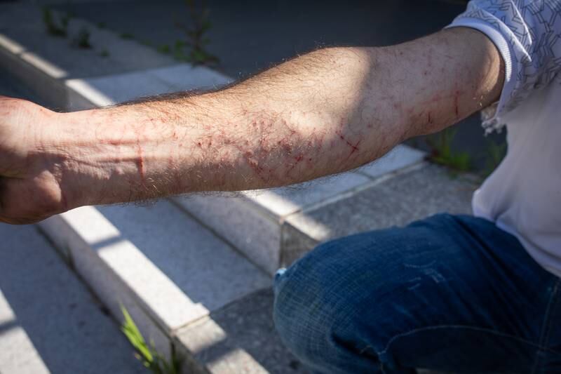A young man shows the cuts to his arm after he was pushed over and beaten as he arrived at the opposition rally. Local residents had gathered to intimidate those arriving for the rally.