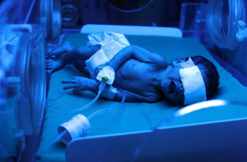A newborn baby lies under observation in an incubator in a ward for malnutritioned newborns at a treatment center Yemen's third largest city of Taez.  AFP