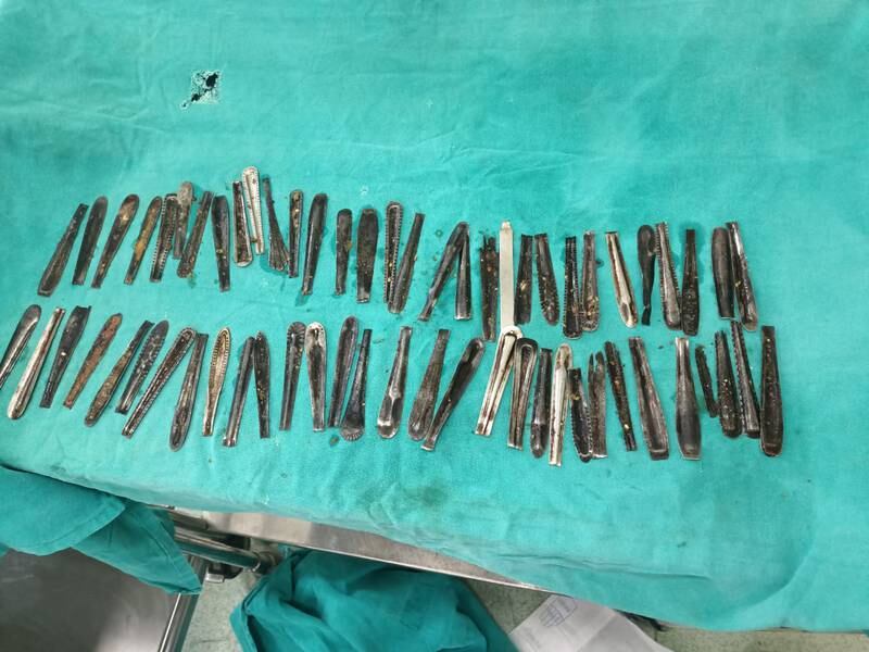 Indian doctors removed 63 steel spoon handles from the stomach of a 32-year-old man in northern Muzaffarnagar city. Photo: Dr Rakesh Khurana