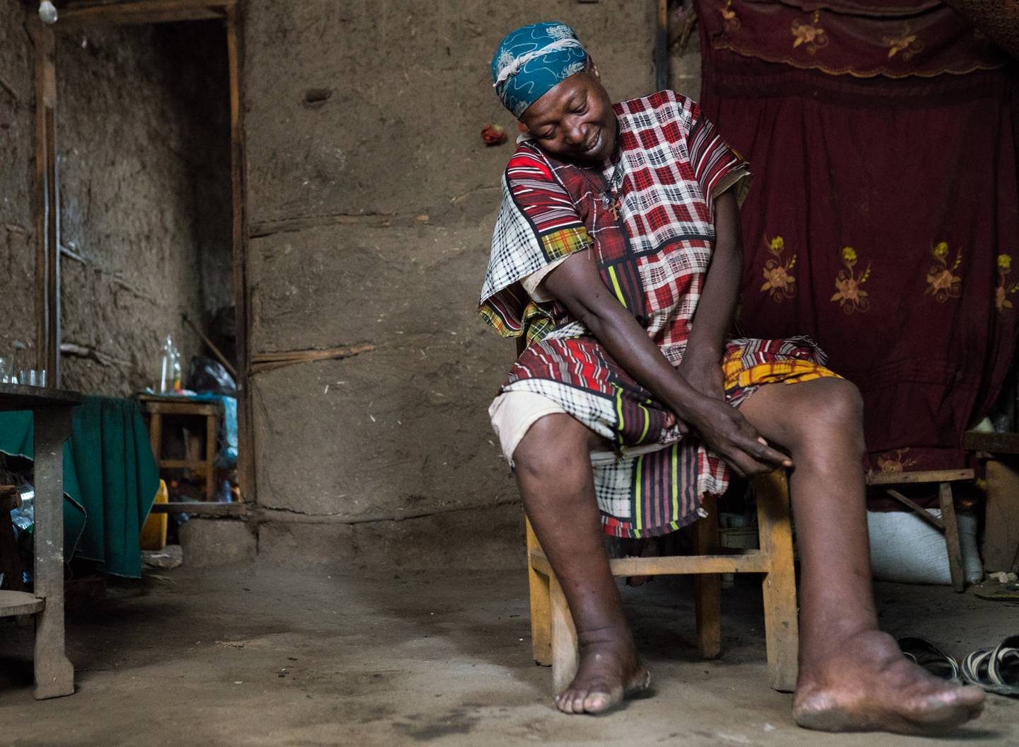 Kesach Fantu in her home in Sankoru, Ethiopia. She also suffers from lymphatic filariasis. Photo: End Fund