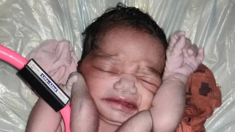 An Indian woman has given birth to a baby girl with two extra arms and legs of her parasitic twin attached to her tiny body. Photo: Dr Umesh Babu