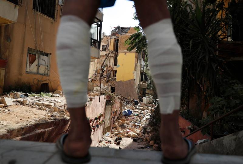 A man who sustained injuries to his legs looks at the rubble. AP Photo