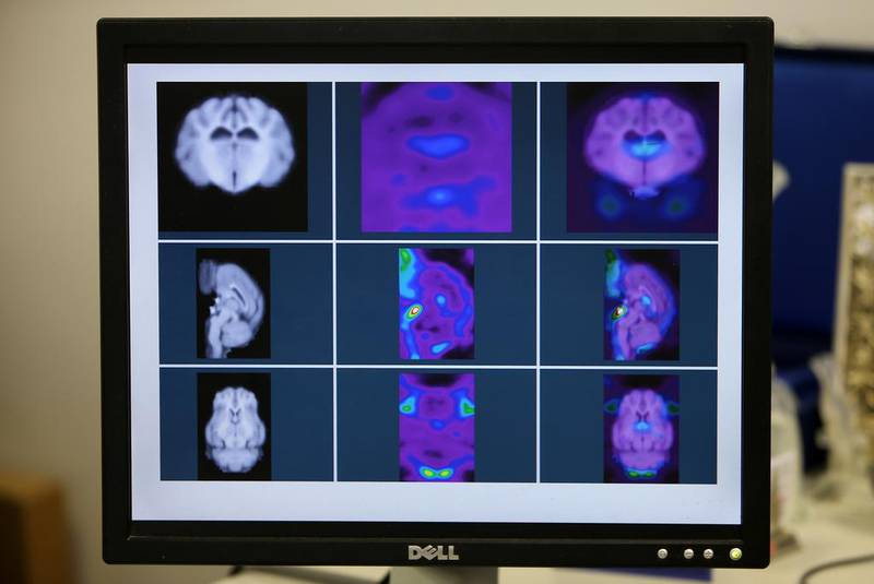 A brain scan can help diagnosis Parkinson’s disease earlier, which may lead to better treatment.  Pawan Singh / The National / March 15, 2015