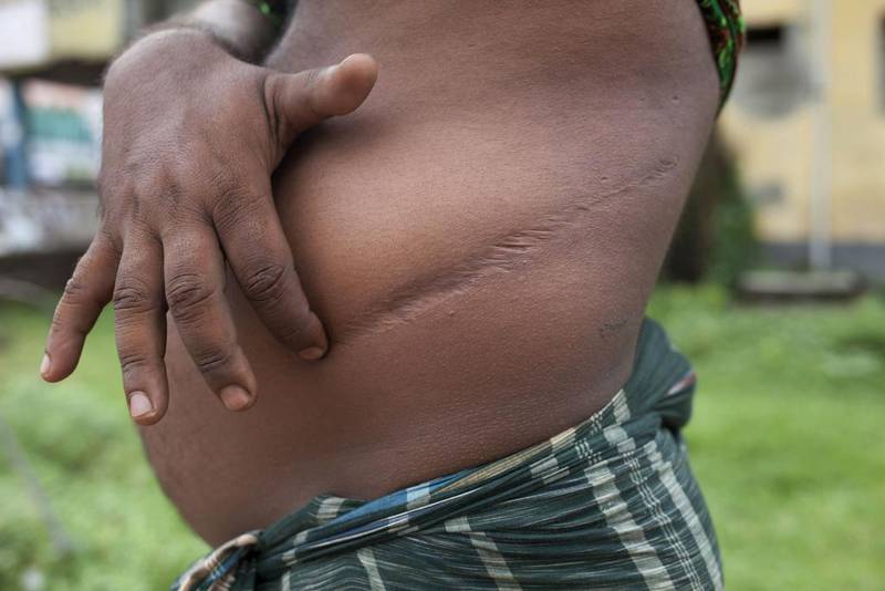 Bangladeshi villager Mokaram Hossian, 35, a victim of illegal organ trade, shows the scars from his illegal kidney removal operation. Suvra Kanti Das / AFP