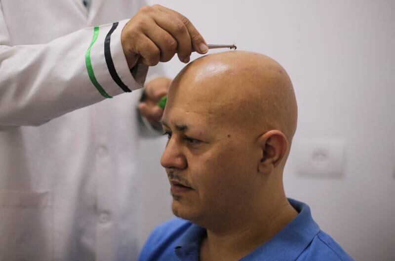 A man, who suffers from alopecia areata, receives bee-sting treatment in Gaza City. Apitherapy, which uses products from bees to treat patients stung by the winged insects, is now at risk