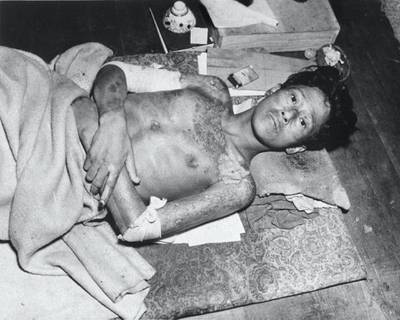 376900 04: (FILE PHOTO) A victim of the atomic bomb explosion in 1945 over Nagasaki, Japan. (Courtesy of the National Archives/Newsmakers)