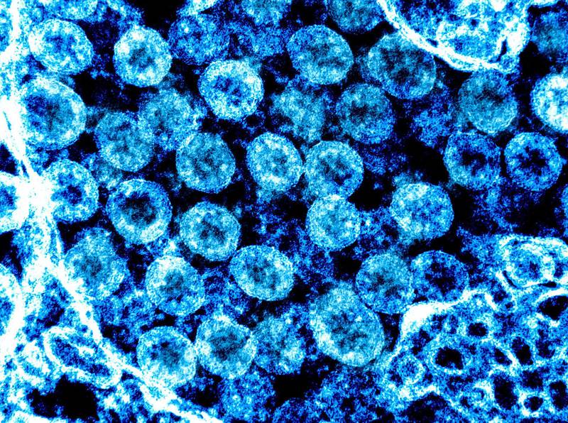 epa08262129 An undated handout picture made available by the National Institutes of Health (NIH) shows a transmission electron micrograph of SARS-CoV-2 virus particles, also known as 2019-nCoV, the virus that causes Covid-19, isolated from a patient (issued 01 March 2020). The image was captured and color-enhanced at the National Institute of Allergy and Infectious Diseases (NIAID) Integrated Research Facility (IRF) in Fort Detrick, Maryland, USA. US health officials announced on 29 February 2020 the first confirmed death from the new coronavirus in the country in Washington State. The novel coronavirus is on the verge of spreading across the world as more Covid-19 cases are emerging outside China with outbreaks in South Korea, Italy and Iran.  EPA/NIAID/NATIONAL INSTITUTES OF HEALTH HANDOUT  HANDOUT EDITORIAL USE ONLY/NO SALES