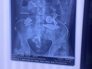 Indian doctors discover bracelet and earphones among 150 objects inside man's stomach