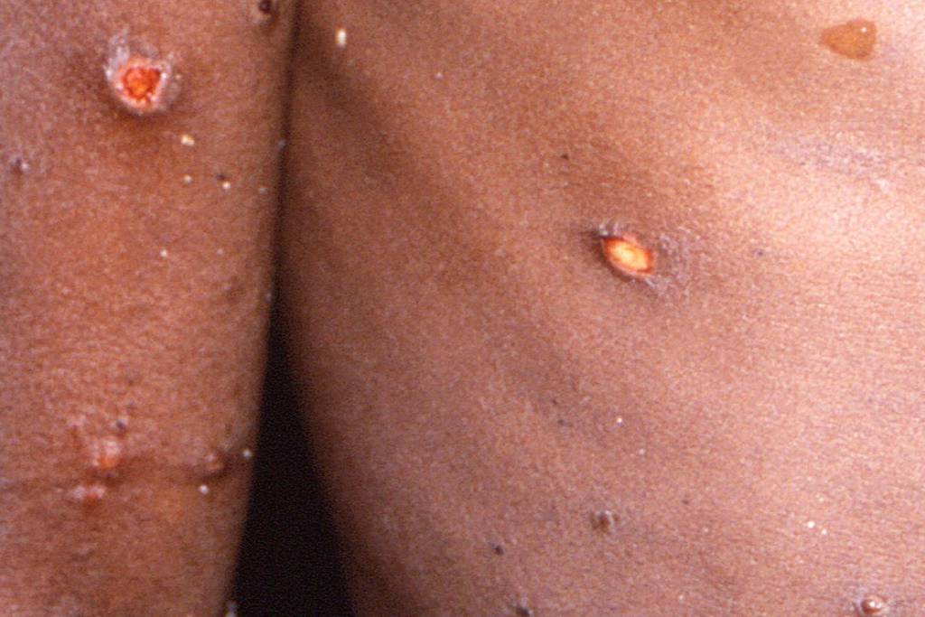 Monkeypox: everything you need to know