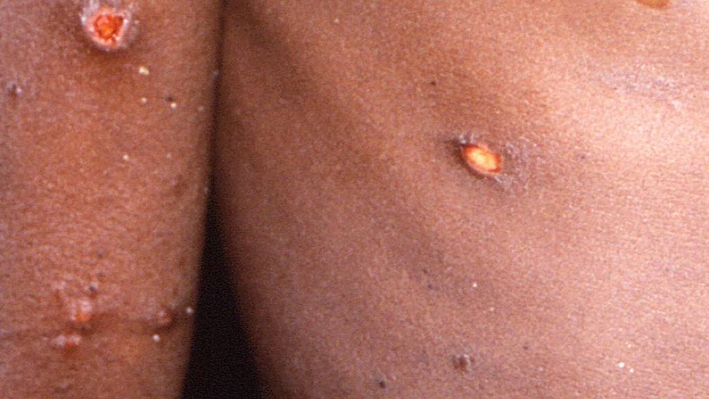 Monkeypox: everything you need to know