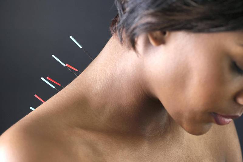 Dry needling uses the same needles as acupuncture, but is a completely different treatment. Getty Images