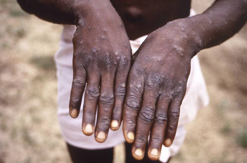 India has recorded its first case of monkeypox, as a man, 35, from Kerala is infected. AP
