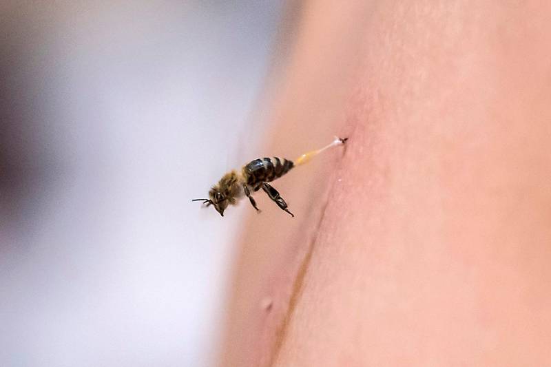 A bee stings the back of a patient receiving treatment at Sayed Al Sayeh's practice in the Egyptian city of Giza. AFP