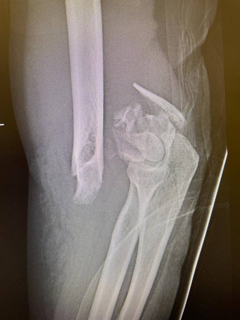 An X-ray of nurse Pinky Caballero's displaced and broken left humerus. Photo: Aster Hospitals