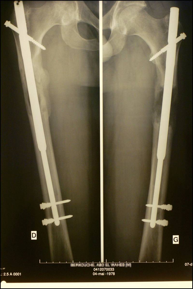 An X-ray of a patient undergoing leg lengthening in France. Getty 