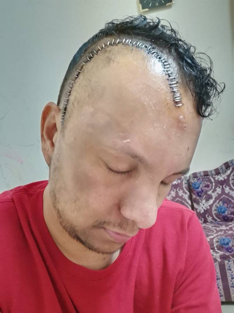 Neurosurgeons at Tawam Hospital in Abu Dhabi performed a brain tumor procedure on Jogin Augustine who was awake but sedated. All photos by Tawam Hospital