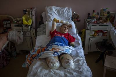 Anton Gladun lies on his bed at the Third City Hospital in Cherkasy, Ukraine, on Thursday, May 5. AP