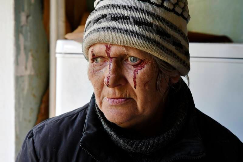 Natalia Rudneva, 59, was injured in overnight shelling in Kramatorsk, Ukraine, that put her son in hospital. AP