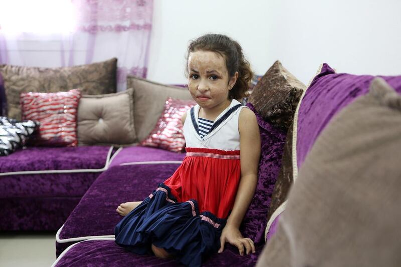 Farah Al Mustafa, 6, needs Dh100,000 to pay for corrective surgery abroad after a bomb in Syria disfigured her. Pawan Singh / The National