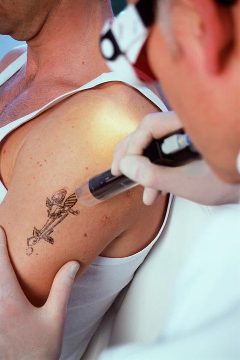 Certain jobs require people to remove tattoos, says a Dubai doctor. Corbis