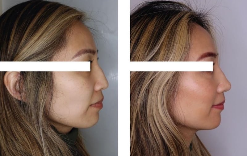 Before and after non surgical rhinoplasty nose filler correction