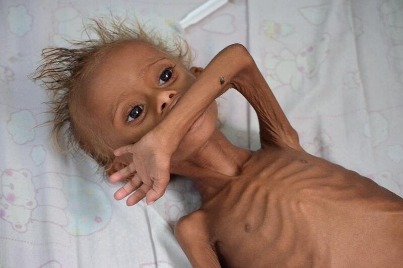 A malnourished boy lies on a bed at a hospital in the Red Sea port city of Houdieda, Yemen. Abduljabbar Zeyad / Reuters