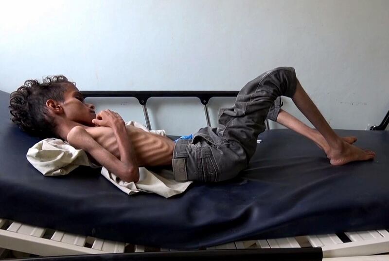 10 year-old Ghazi Saleh lies on a bed at Al-Mudhafar hospital in Taez on November 19, 2018. Skin and bones, 10-year-old Ghazi Saleh lies on a hospital bed in the southwestern Yemeni city of Taez barely breathing. He only weighs eight kilogrammes. Starving and too weak to move or even cry, Ghazi can only look down at his emaciated body as he struggles to keep his eyes open. / AFP / marzooq AL-JABIRY / TO GO WITH AFP STORY by Marzooq al-Jabiry and Dana Moukhallati
