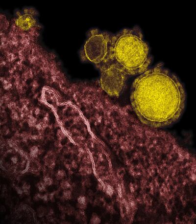 An electron microscope image shows coronavirus particles, also known as the Mers virus, in yellow. AP