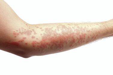 Psoriasis affects some 125 million people around the world. Getty