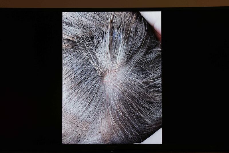 Evidence presented by US actress Amber Heard showing a bald spot in her head. AFP